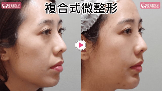 複合式微整形029