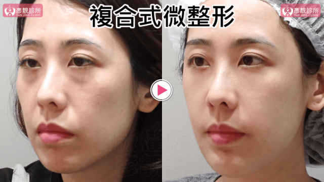 複合式微整形030