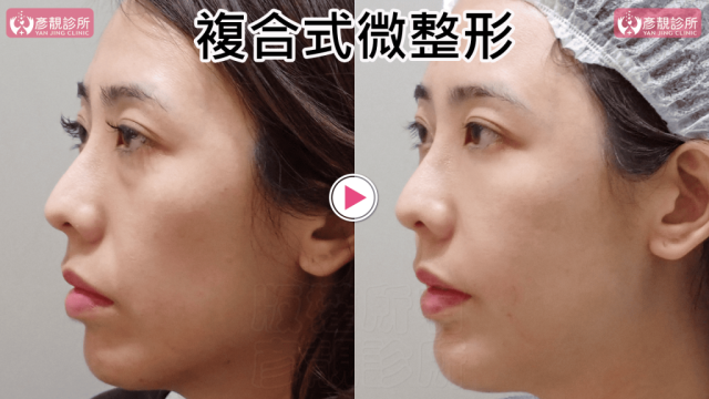 複合式微整形032