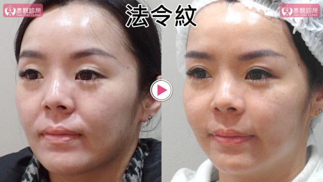 女性法令紋術前術後斜側近照，右圖鼻翼基底旁上段折線較淺，臉頰前側至口周的陰影縮短；4D無痕筋膜提升依中臉支撐方向分配大分子玻尿酸，並把材料留在預定層次以降低位移
