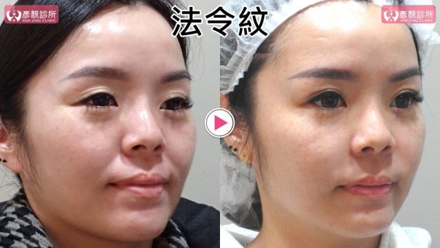 女性法令紋術前術後斜側近照，右圖蘋果肌下緣與鼻唇溝交界較平順，中臉外側陰影減少；大分子玻尿酸依組織層次建立支撐，並以相同角度持續追蹤法令紋改善的持久狀態