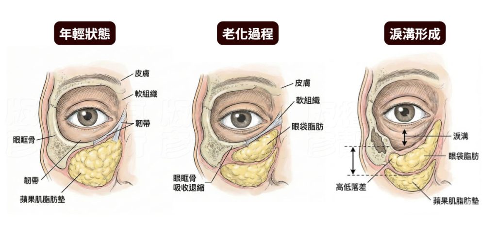 淚溝凹陷老化演變