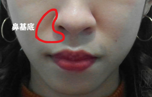 鼻基底凹陷位置