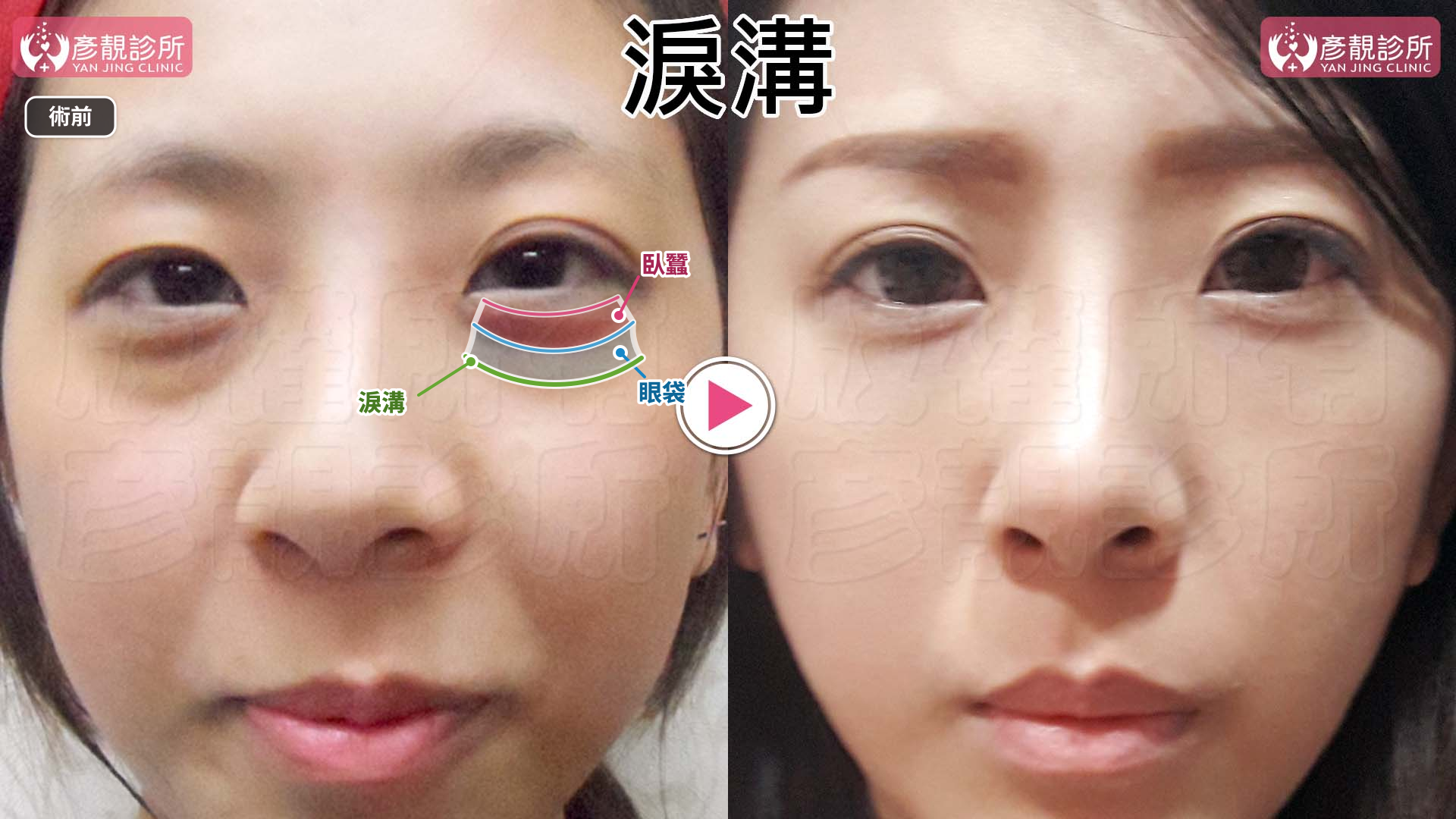 淚溝是黑眼圈的主因:比色素、血管更常見、更好改善 2 淚溝、眼袋與臥蠶位置標示的眼下術前術後對照;左側術前以粉紅、藍、綠分別標出臥蠶、眼袋與淚溝,右側可見眼下凹凸銜接較平順,並保留自然的臥蠶輪廓。