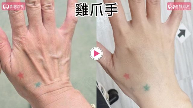 雞爪手 1 1024x576